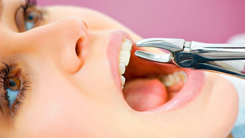 مراقبتهای بعد از کشیدن دندان در کودکان
